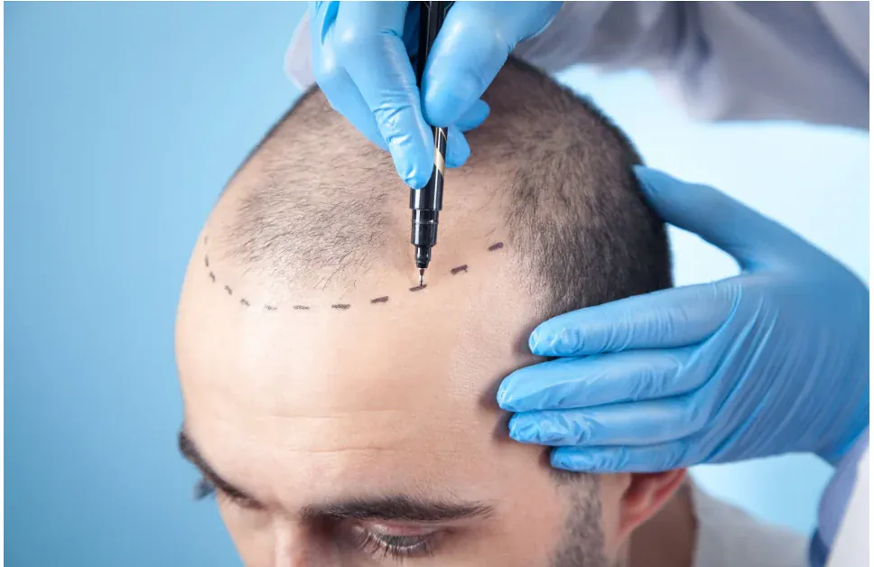 Hair Transplant & PRP / GFC / Exosome Therapy