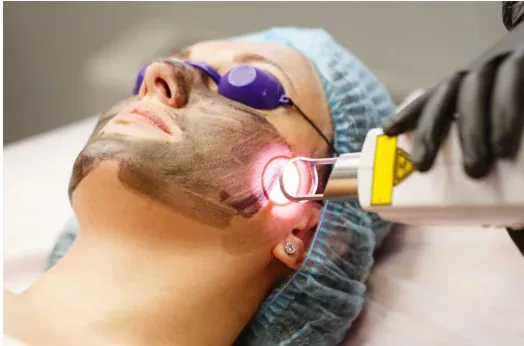 Carbon Laser Peel